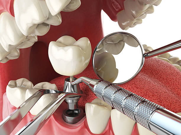 Best Emergency Root Canal Treatment in Quail Creek, TX